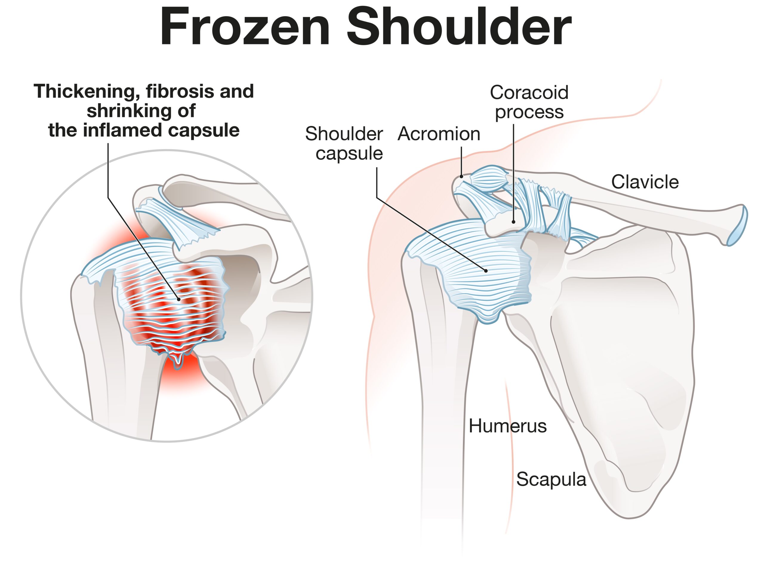 Een frozen shoulder, ook wel adhesieve capsulitis genoemd