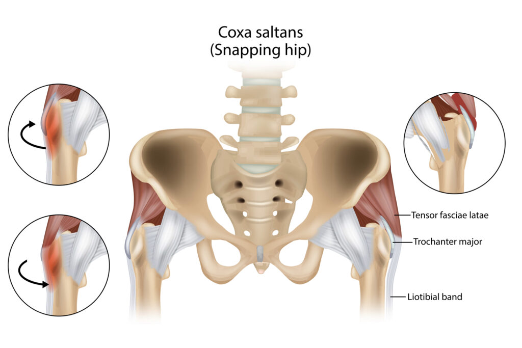Een diagram illustreert het snapping hip syndroom, waarbij een peesband over het bovenbeen glijdt, veroorzaakt door overbelasting, slechte houding of andere factoren.