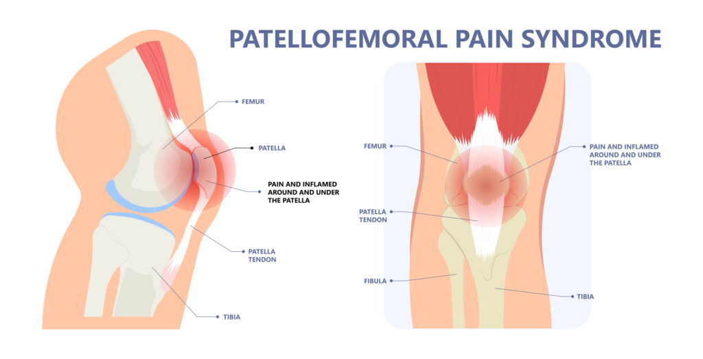 Een diagram dat de anatomie van het patellofemorale gewricht illustreert, waarbij het dijbeen (femur) en de knieschijf (patella) verbonden zijn. Diverse anatomische structuren, inclusief spieren, pezen en ligamenten, worden benadrukt.