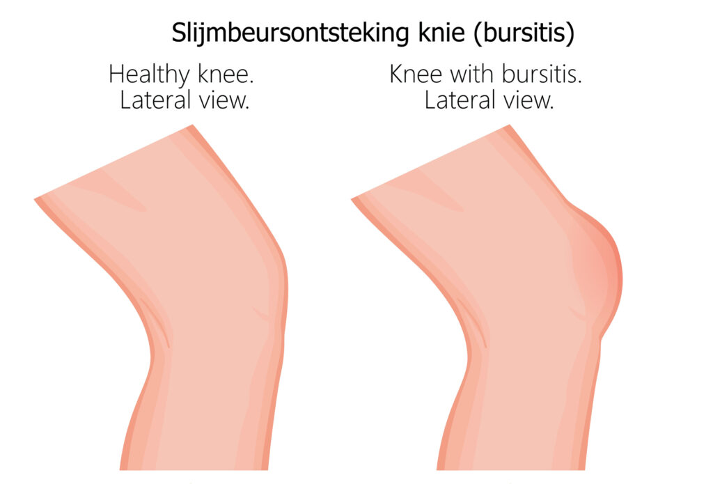 Afbeelding van een knie met slijmbeursontsteking, zichtbaar als zwelling en roodheid.