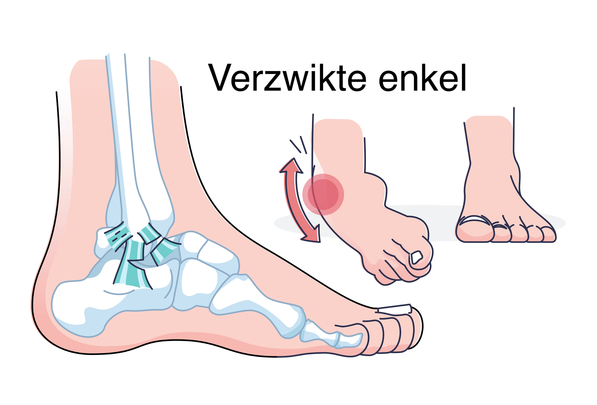 Close-up van een verzwikte enkel met zichtbare zwelling en verkleuring, tijdens een fysiotherapeutische behandeling.