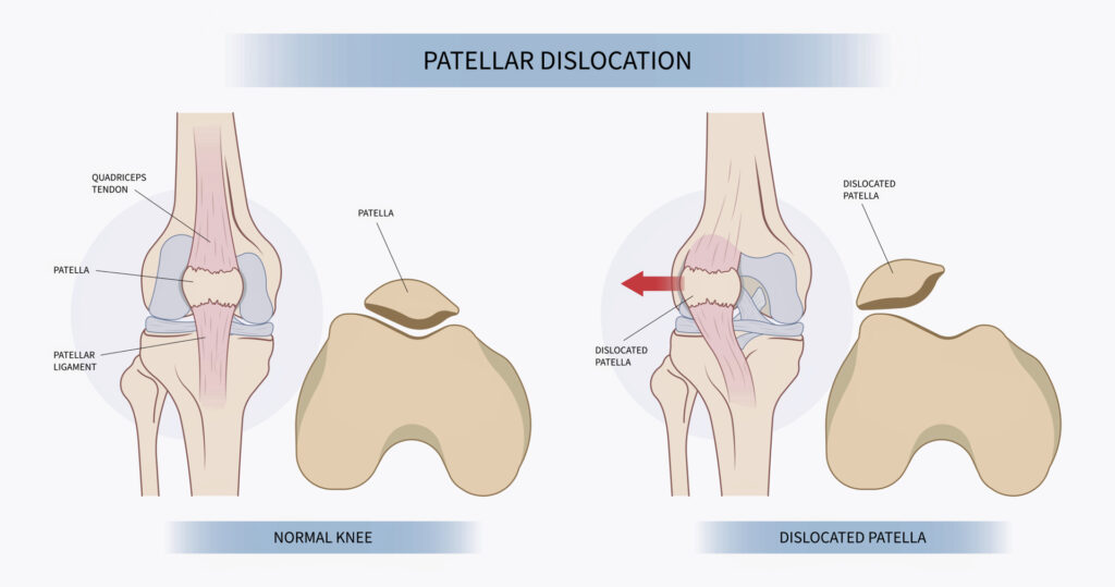 Diagram van een normale knie en een knie met patella luxatie.